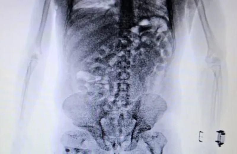 En el aeropuerto de Ezeiza, detuvieron una mula que viajaba a Europa con 84 cápsulas de cocaína en el cuerpo En el aeropuerto de Ezeiza, detuvieron una mula que viajaba a Europa con 84 cápsulas de cocaína en el cuerpo