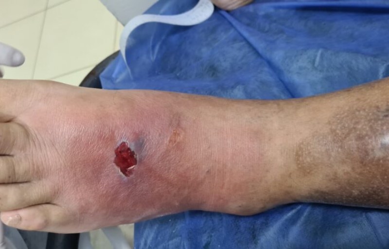 Pie diabético, una problemática con alta tasa de recurrencia, reinternaciones y mortalidad Pie diabético, una problemática con alta tasa de recurrencia, reinternaciones y mortalidad