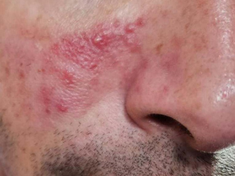 Estudian la relación entre parásitos cutáneos con tres enfermedades frecuentes de la piel Estudian la relación entre parásitos cutáneos con tres enfermedades frecuentes de la piel