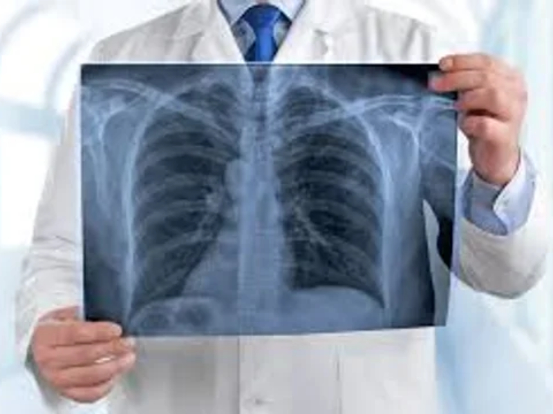 Día Mundial del Cáncer de Pulmón: alertan sobre el aumento de casos Día Mundial del Cáncer de Pulmón: alertan sobre el aumento de casos