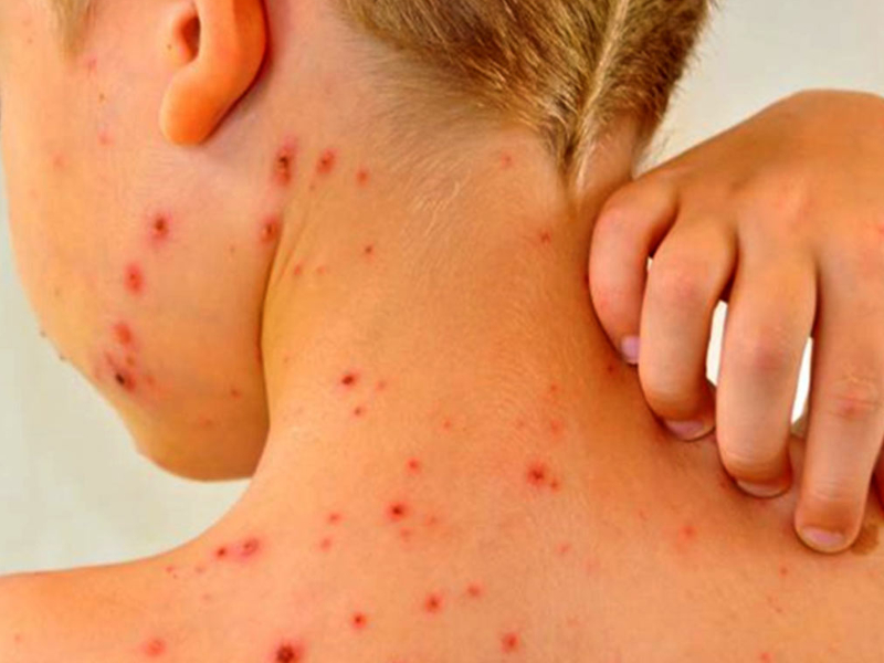 Nueva alerta por sarampión: una familia uruguaya contagiada y sin vacuna viajó por el país Nueva alerta por sarampión: una familia uruguaya contagiada y sin vacuna viajó por el país