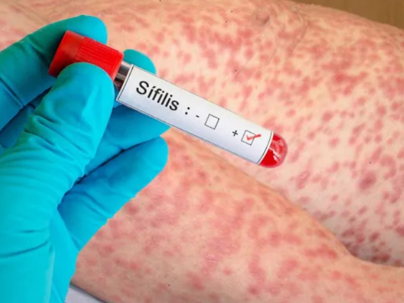 Entre 2020 y 2022, aumentaron un 30% los casos de sífilis Entre 2020 y 2022, aumentaron un 30% los casos de sífilis