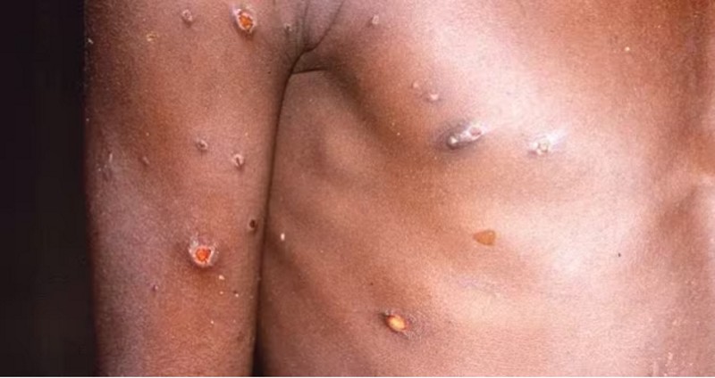 La OMS declaró la emergencia médica mundial por el brote de viruela del mono en África La OMS declaró la emergencia médica mundial por el brote de viruela del mono en África