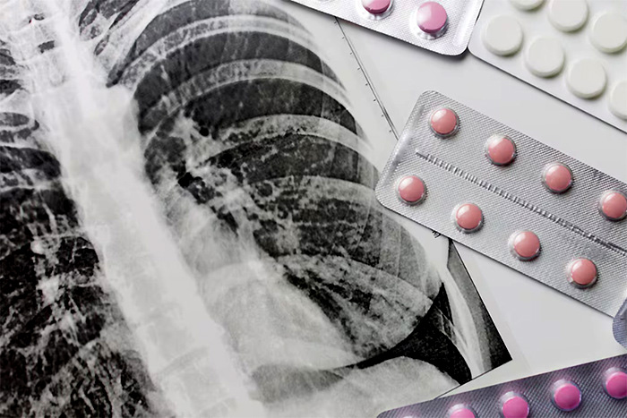 “Millones de vidas” en riesgo por el recorte de Estados Unidos contra la tuberculosis “Millones de vidas” en riesgo por el recorte de Estados Unidos contra la tuberculosis