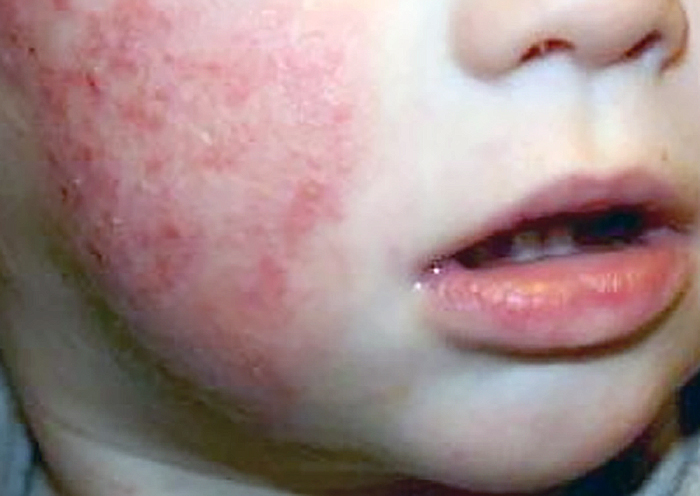 Misiones se suma a la campaña nacional para la detección de la dermatitis atópica Misiones se suma a la campaña nacional para la detección de la dermatitis atópica