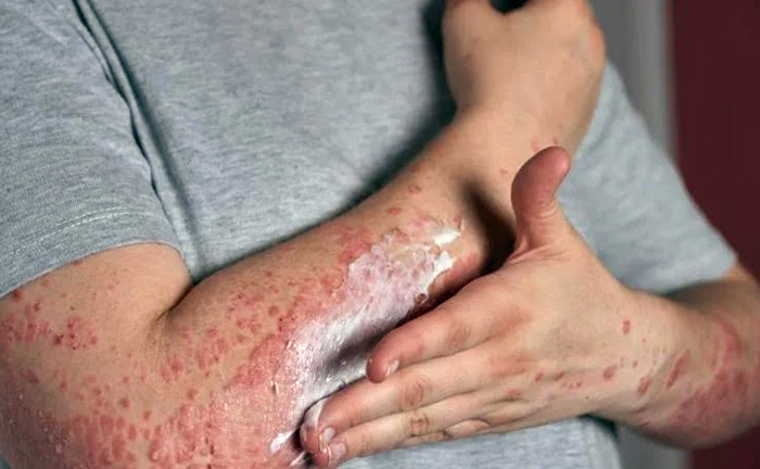 Salta confirmó 11 casos activos de lepra y hay alerta sanitaria en la vecina provincia Salta confirmó 11 casos activos de lepra y hay alerta sanitaria en la vecina provincia