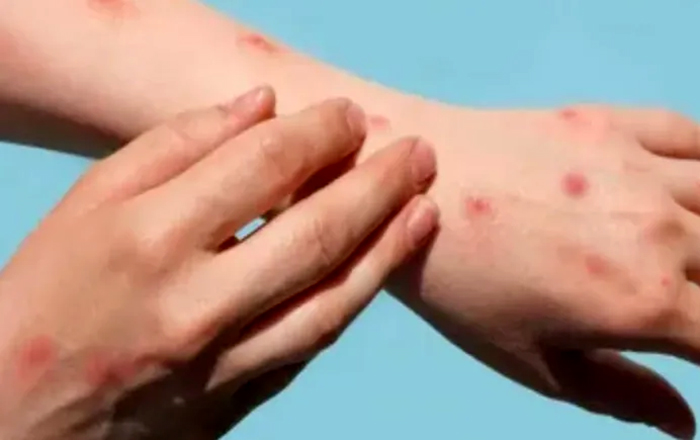 Leishmaniasis en Misiones: Boletín Nacional confirma 14 casos en el último año Leishmaniasis en Misiones: Boletín Nacional confirma 14 casos en el último año